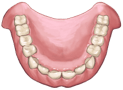 Denture