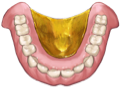 Denture