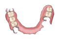 Denture